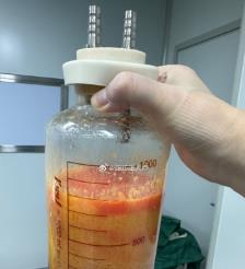 香港水动力吸脂手术要做多久？